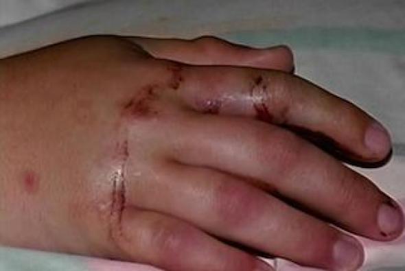 snake bite